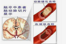 如何预防脑梗、心梗